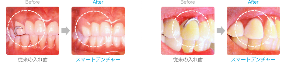 従来の入れ歯とスマートデンチャーの比較